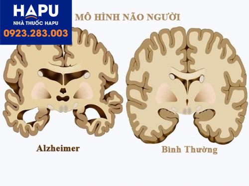 Bệnh-Alzheimer-là-bệnh-gì