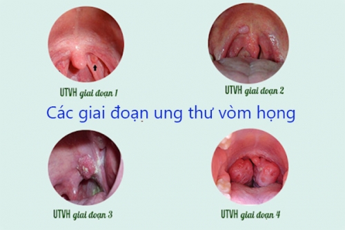 Các-giai-đoạn-ung-thư-vòm-họng