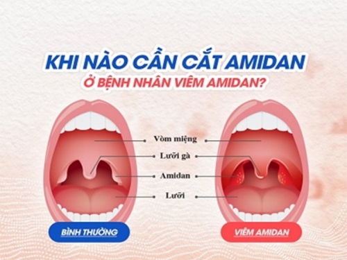 Khi-nào-cần-cắt-amidan-trong-bệnh-viêm-amidan