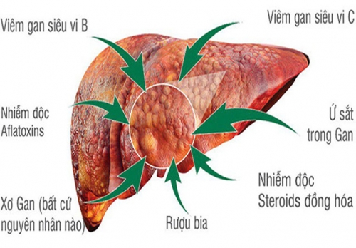 Nguyên-nhân-gây-ra-vôi hóa gan