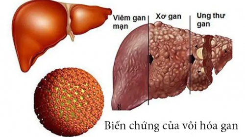 Nốt-vôi-hóa-gan-có-nguy-hiểm-không