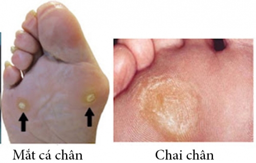 Phân-biệt-bệnh-mắt-cá-chân-và-chai-chân