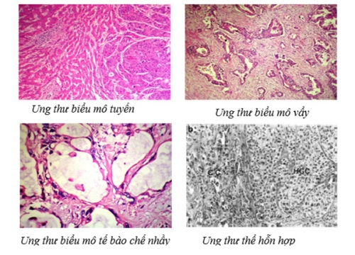 Ung-thư-biểu-mô-tế-bào-gan-phân-loại