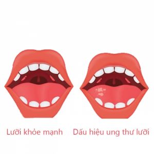 Dấu hiệu ung thư lưỡi