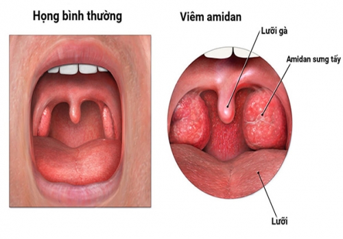 Viêm-amidan-là-gì