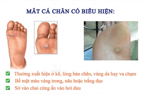 biểu-hiện-bệnh-mắt-cá-chân