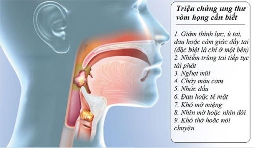 dấu-hiệu-ung-thư-vòm-họng