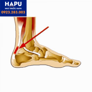 viêm gân gót chân Achilles