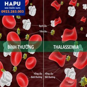 Hội-chứng-tan-máu-thalassemia