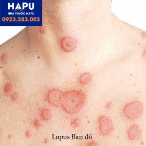 bệnh lupus-ban-đỏ-là-gì