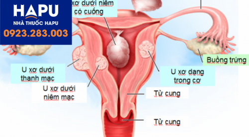 U xơ tử cung khi mang thai- Những điều bà bầu cần biết