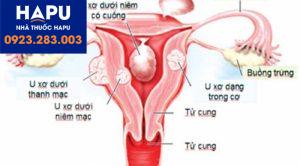 U xơ tử cung có nguy cơ chuyển biến thành ung thư không?