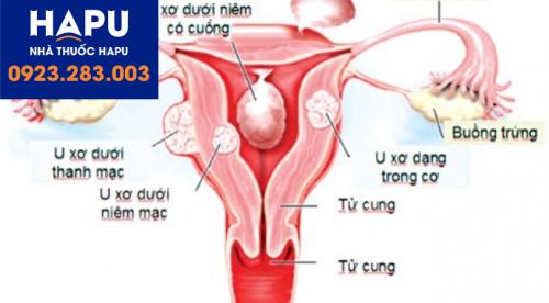 U xơ tử cung có mang thai được không