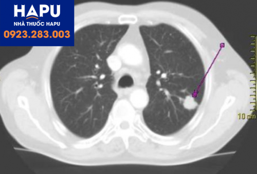 Ung thư phổi có thể được chẩn đoán ở giai đoạn sớm không?