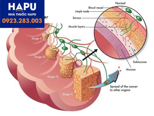 Ung thư đại tràng giai đoạn 2 có chữa được không?