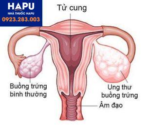 Ung thư buồng trứng và các phương pháp để tầm soát