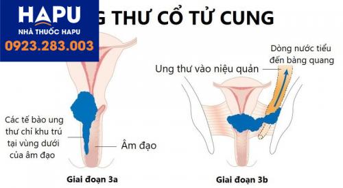 Triệu chứng ung thư cổ tử cung giai đoạn 3 và cách điều trị hiện nay