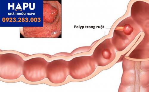 Polyp đại - trực tràng ở trẻ em