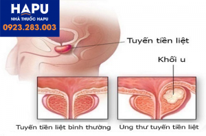 Xét nghiệm PSA trong chẩn đoán ung thư tiền liệt tuyến ?