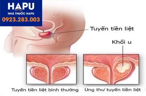 Xét nghiệm nào được dùng để phát hiện ung thư tiền liệt tuyến?