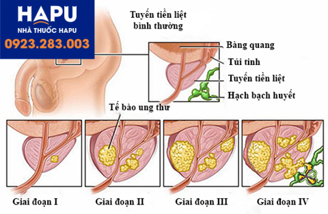 ung thư tuyến tiền liệt giai đoạn cuối