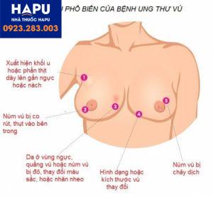 Tiên lượng thời gian sống của bệnh nhân ung thư vú theo từng giai đoạn