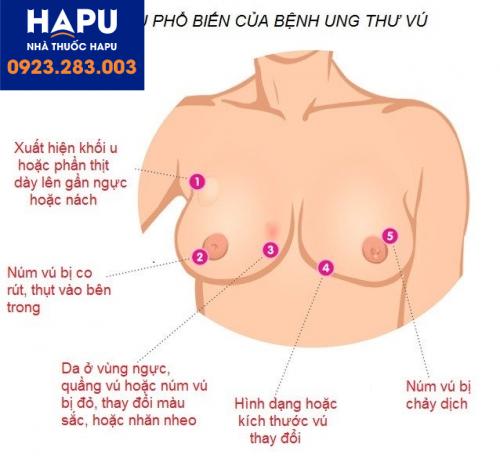 Tiên lượng khả năng sống của bệnh nhân ung thư vú theo từng giai đoạn