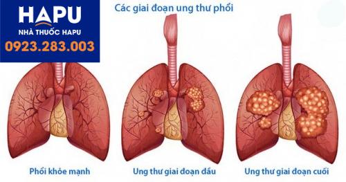 ung-thu-phoi-2