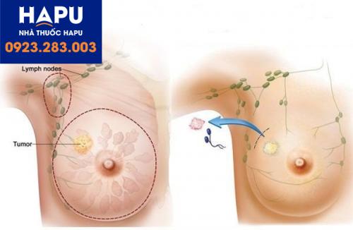 Phẫu thuật bảo tồn tuyến vú hay cắt toàn bộ tuyến vú