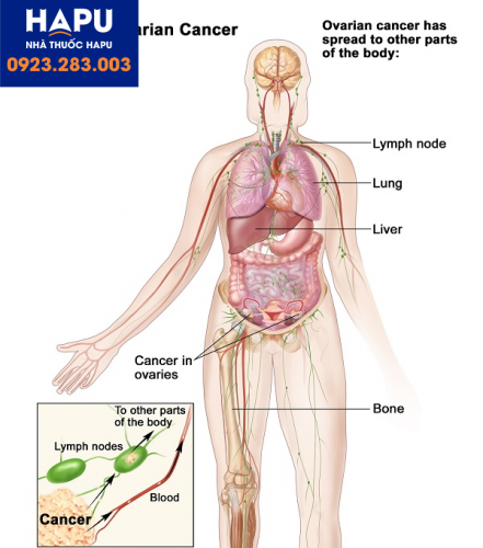 Các biện pháp cần thực hiện để chẩn đoán ung thư buồng trứng