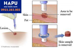 Vai trò của phương pháp sinh thiết trong chẩn đoán ung thư da