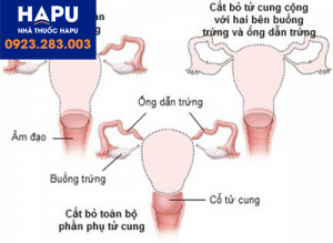 Nguy cơ bị ung thư buồng trứng sau khi phẫu thuật cắt tử cung