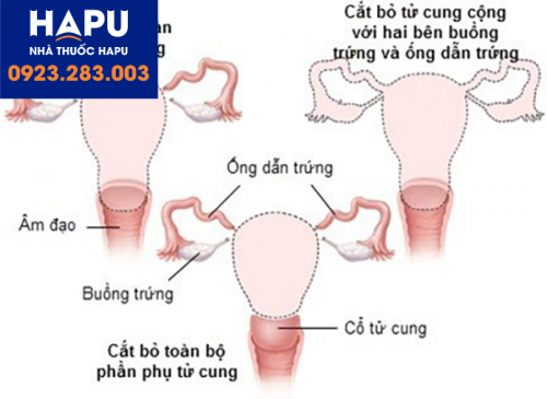 Các phương pháp cắt bỏ tử cung