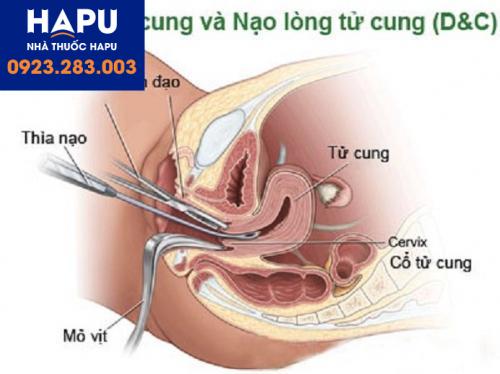 Nong nạo cổ tử cung