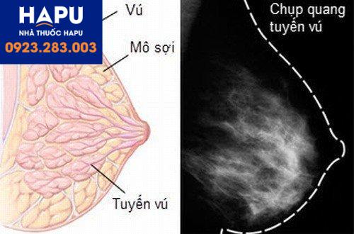 Nổi u hạch ở nách: Cảnh giác ung thư vú