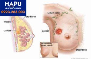 Nổi u hạch ở nách: Cảnh giác với bệnh ung thư vú