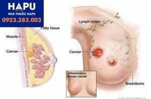 Các dấu hiệu của bệnh ung thư vú ở nữ giới và chẩn đoán bệnh