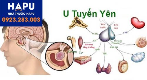 Các triệu chứng của u tuyến yên