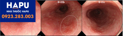 Ung thư thực quản giai đoạn sớm được nhìn thấy qua nội soi