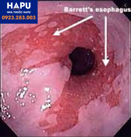 Hình ảnh Barret’s thực quản