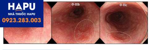 Hình ảnh ung thư sớm ở thực quản
