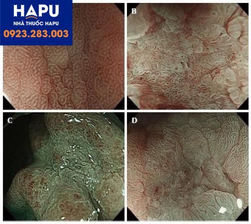 nội soi đại diện của mô hình vi bề mặt niêm mạc của ung thư dạ dày giai đoạn sớm dạng lõm