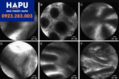 Hình ảnh nội soi phóng đại bằng Laser đồng tiêu