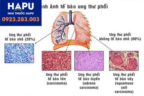 ung thư biểu mô phổi tế bào vảy