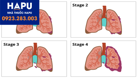 các giai đoạn ung thư phổi