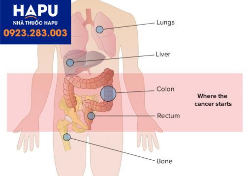 Ung thư đại trực tràng di căn