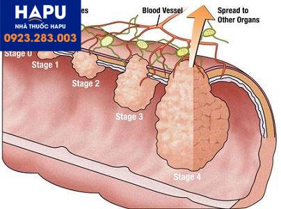 các giai đoạn ung thư đại trực tràng