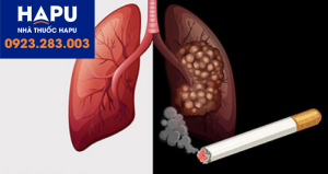 Tìm hiểu ung thư phổi giai đoạn 4 , điều gì sẽ xảy ra ?