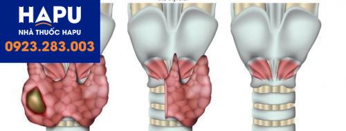 Điều trị ung thư tuyến giáp bằng phương pháp lobectomy