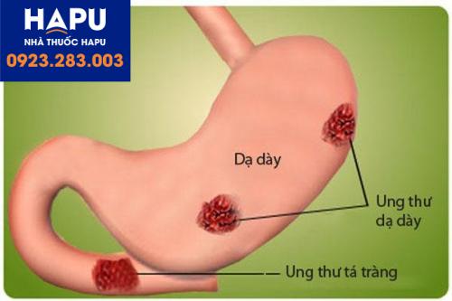 Tìm hiểu về ung thư dạ dày